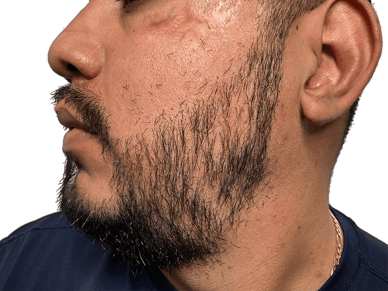 Beard Transplant Case 7 – After