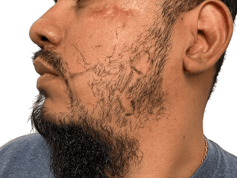 Beard Transplant Case 7 – Before