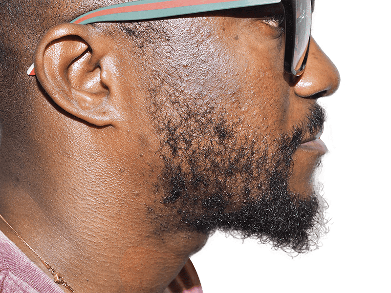 Beard Transplant Case 8 – After