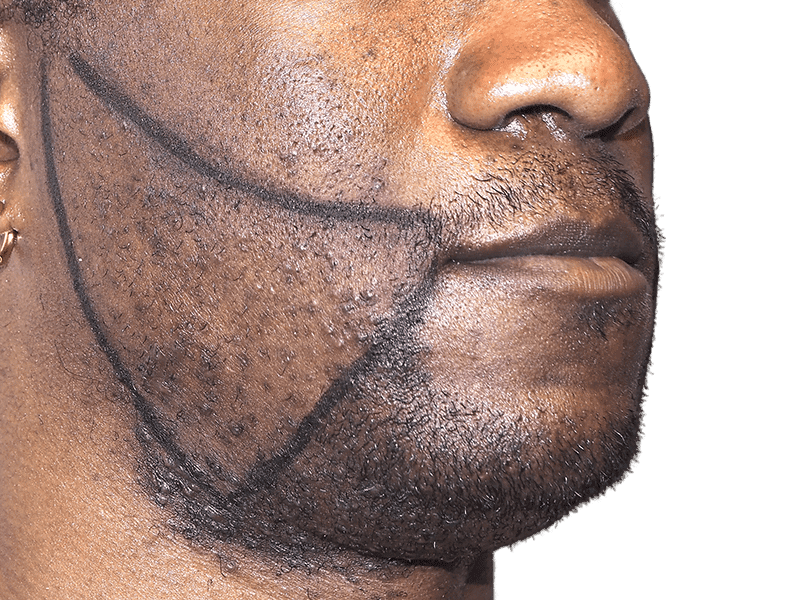 Beard Transplant Case 8 – Before