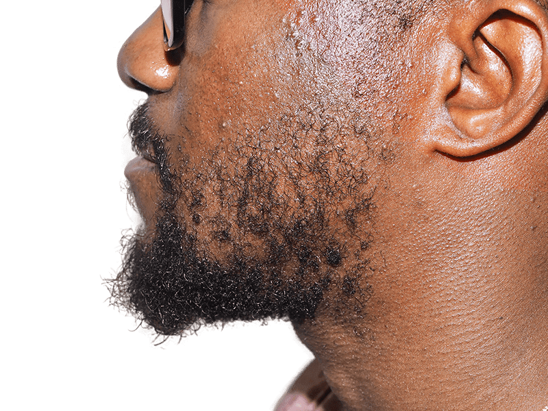 Beard Transplant Case 8 – After