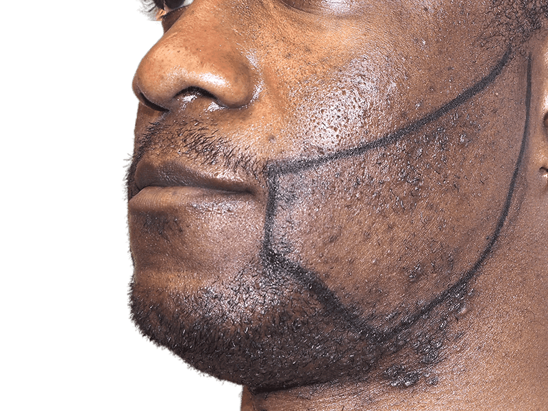 Beard Transplant Case 8 – Before