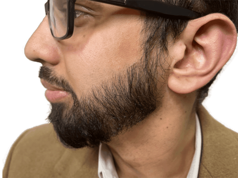 Beard Transplant Case 9 – After