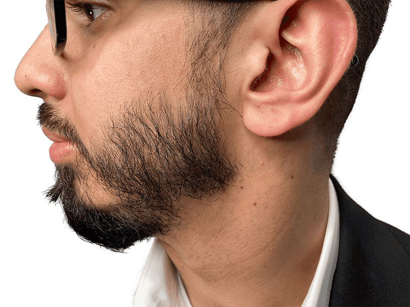 Beard Transplant Case 9 – Before