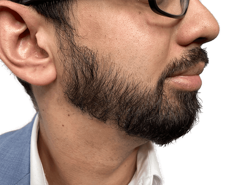 Beard Transplant Case 9 – After
