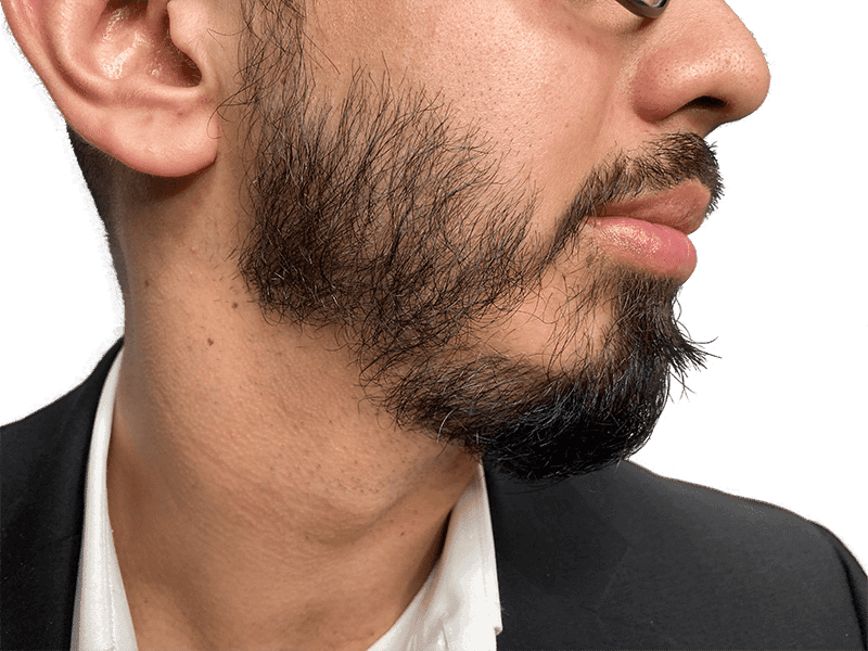 Beard Transplant Case 9 – Before