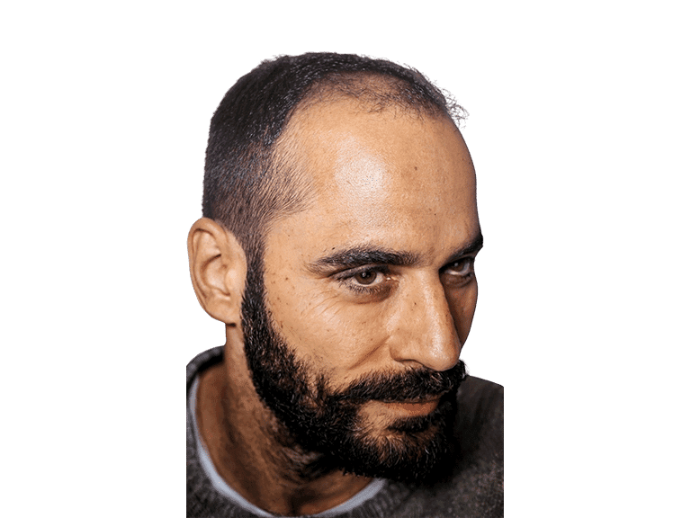 Full Face 0001 – Before