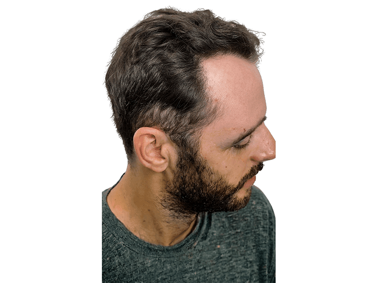 Full Face 0003 – After