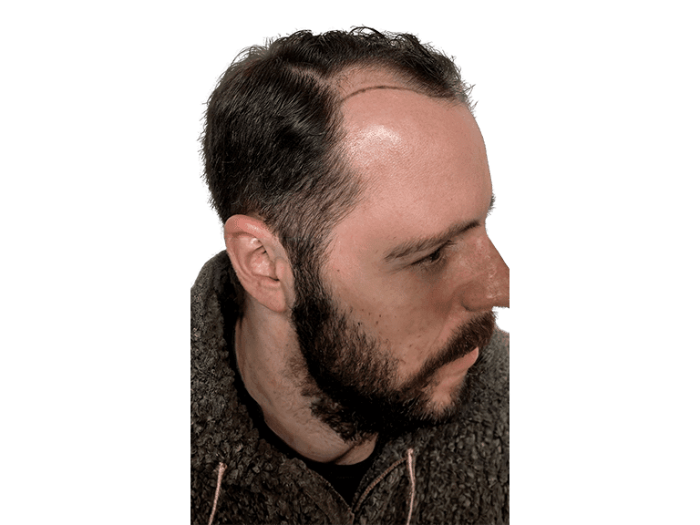 Full Face 0003 – Before