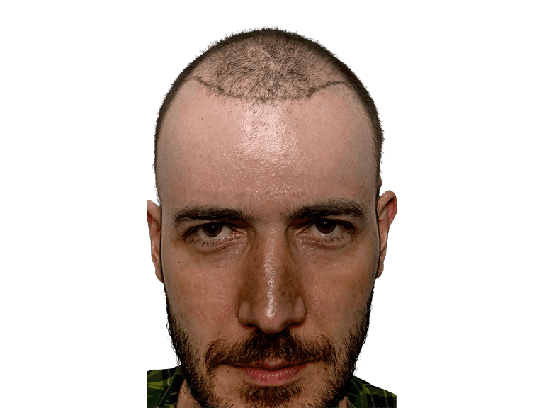 Full Face 0010 – Before