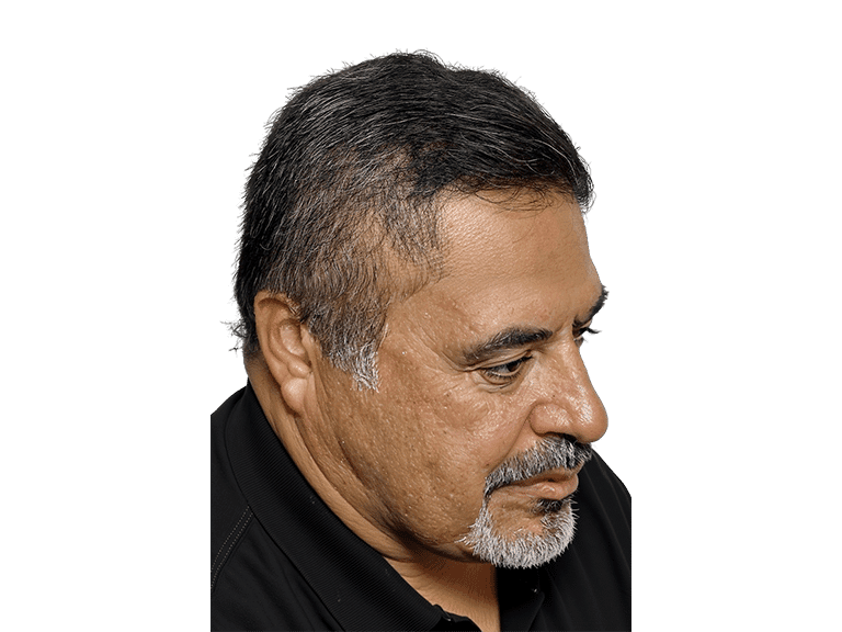 Full Face 0011 – After