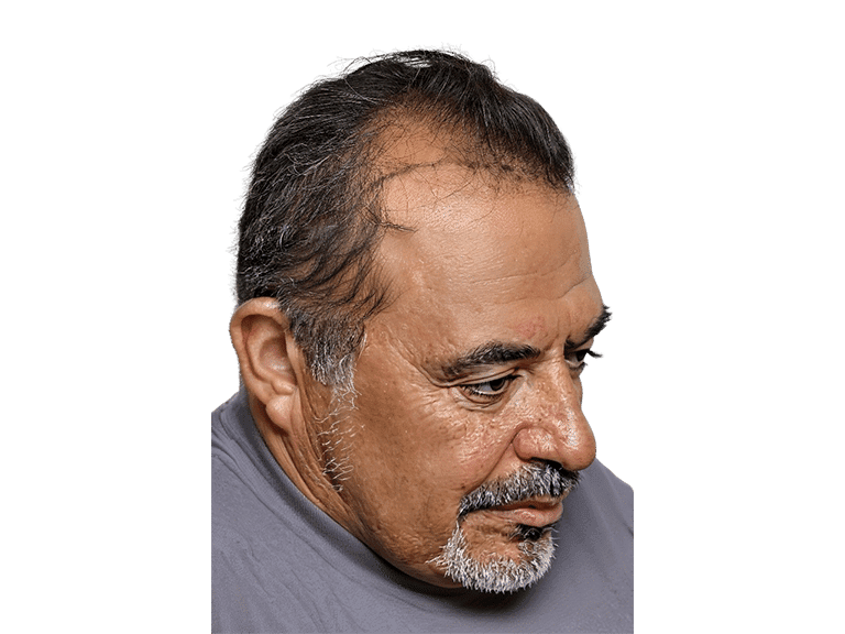 Full Face 0011 – Before