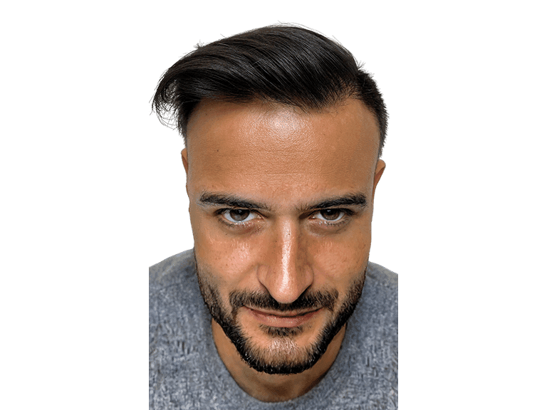 Full Face 0022 – After