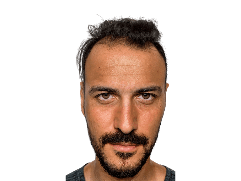 Full Face 0022 – Before