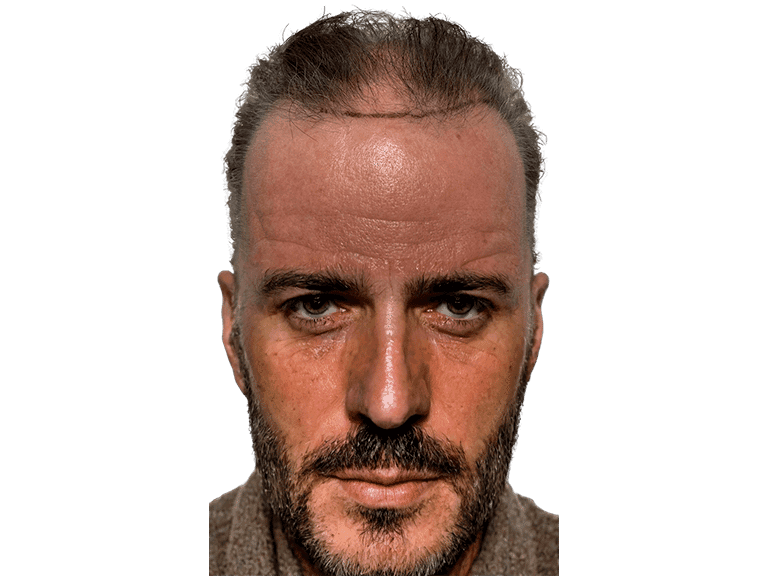 Full Face 0025 – Before