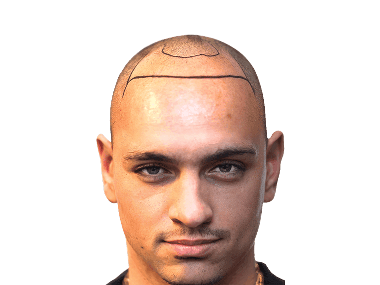 Full Face 0026 – Before