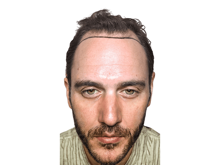 Full Face 0027 – Before