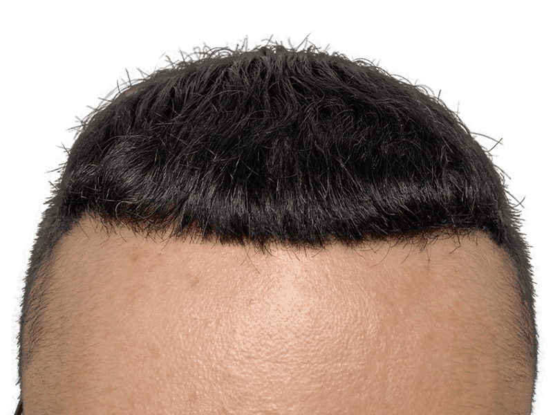 FUE Case 4 – After
