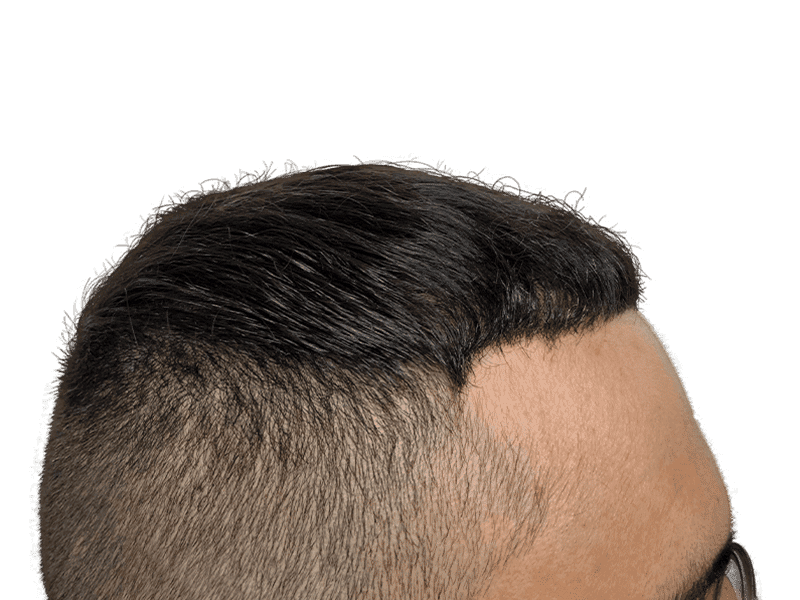 FUE Case 4 – After