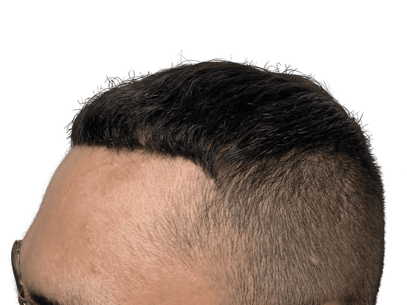 FUE Case 4 – After