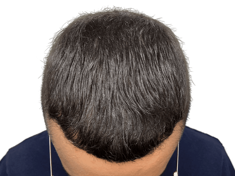 FUE Case 4 – After