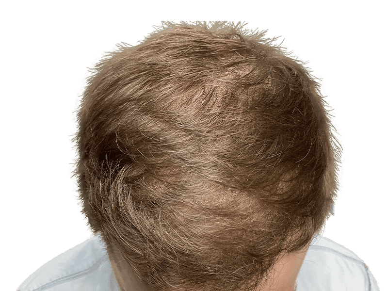 FUE Case 9 – After