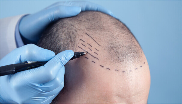 Body to scalp hair transplants