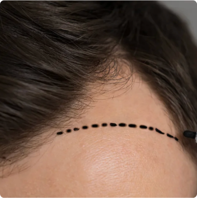 Hair restoration results: Before & after showcasing natural hairline. See our hair transplant success stories.
