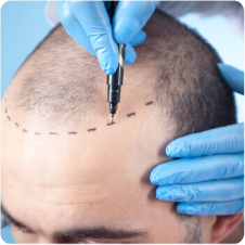Hair Restoration is our Specialty