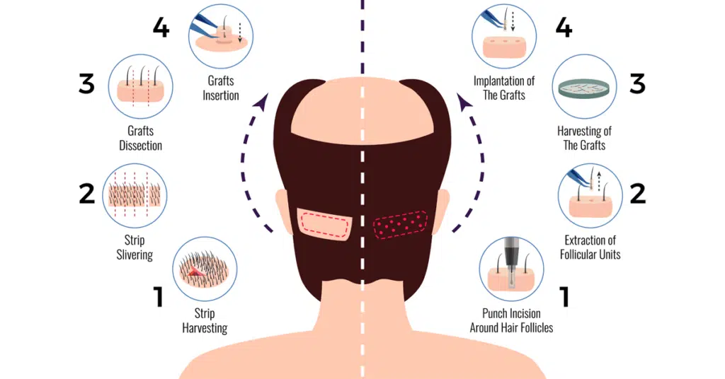 FUE & FUT Hair Transplant Comparison