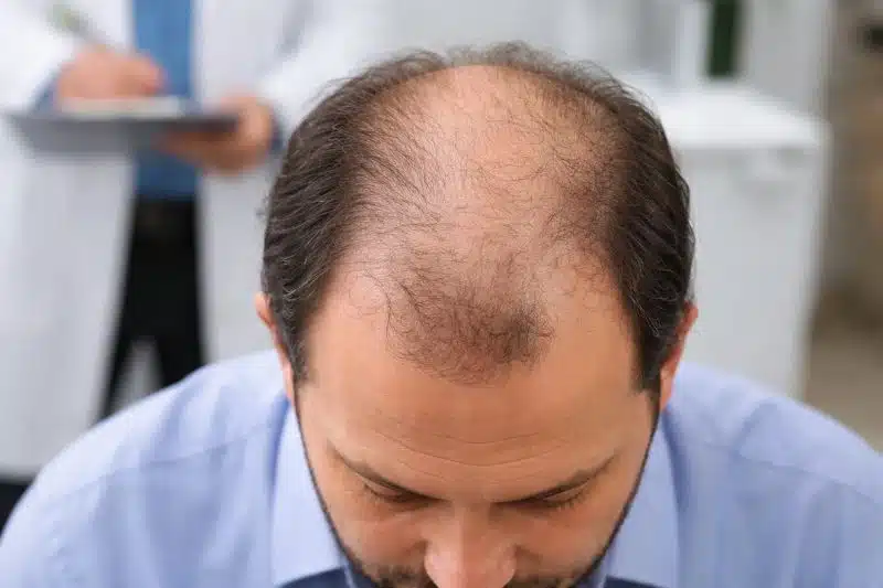 Advanced crown baldness visible from above, representing later stages in 7 stages of hair loss