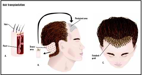 facts about hair transplant