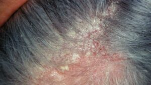 Scalp Eczema Disorder