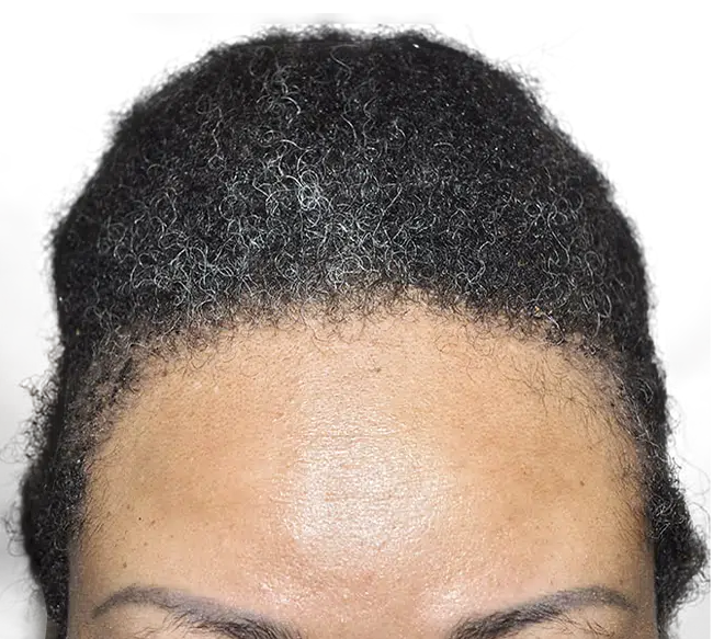 Hair Transplants for Curly Hair