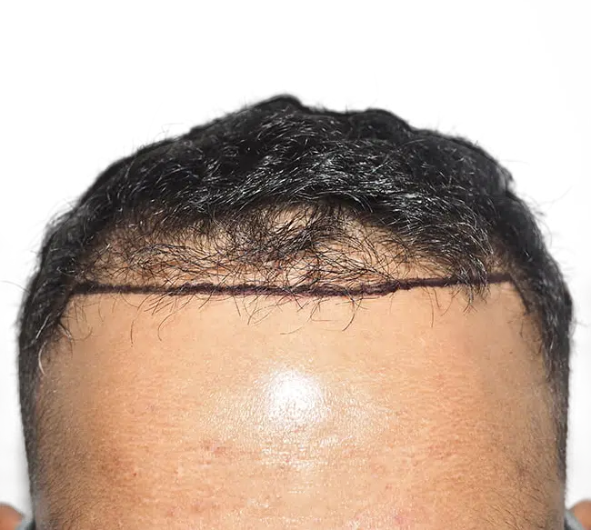 Hair Transplants for Curly Hair