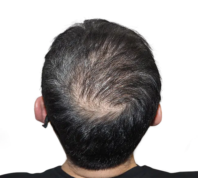 After Crown Hair Transplant 2