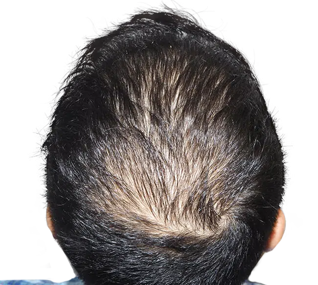 Before Crown Hair Transplant
