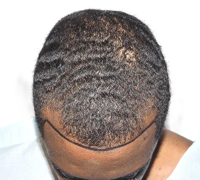 Hair Transplants for Curly Hair