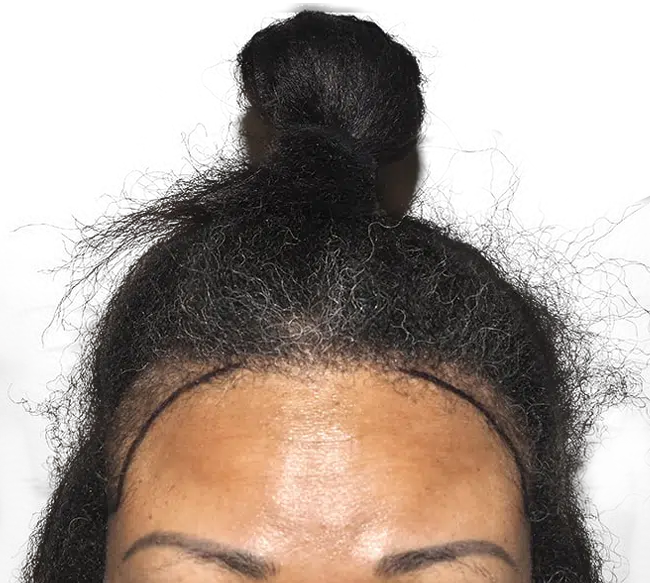 Hair Transplants for Curly Hair