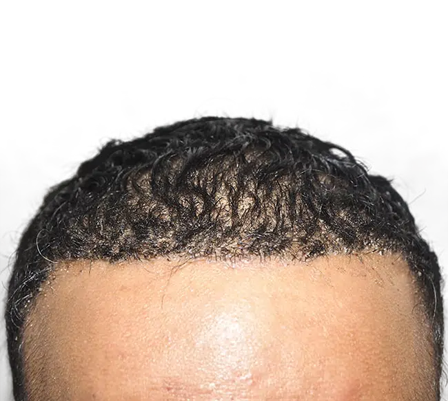 Hair Transplants for Curly Hair