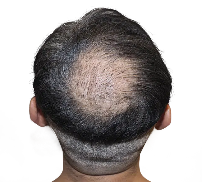 Before Crown Hair Transplant 2