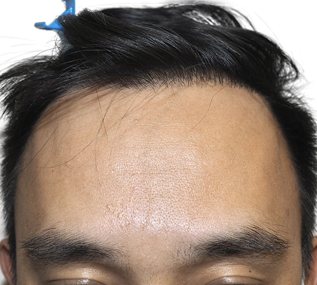 FUE Hair Transplants in Tampa, FL