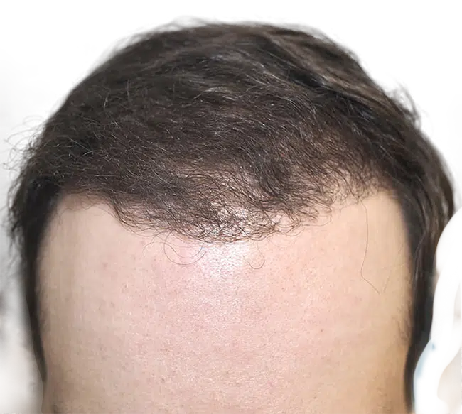 FUE Hair Transplants in New York City, NY