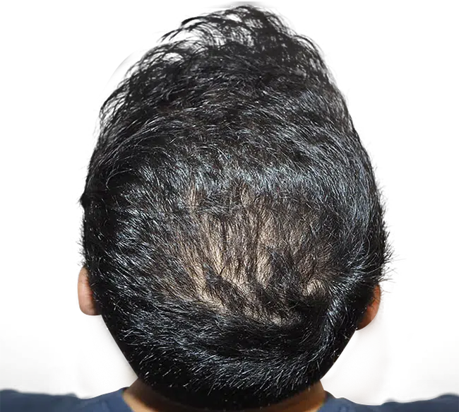 After Crown Hair Transplant