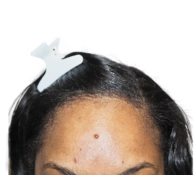 African American Hair Transplant