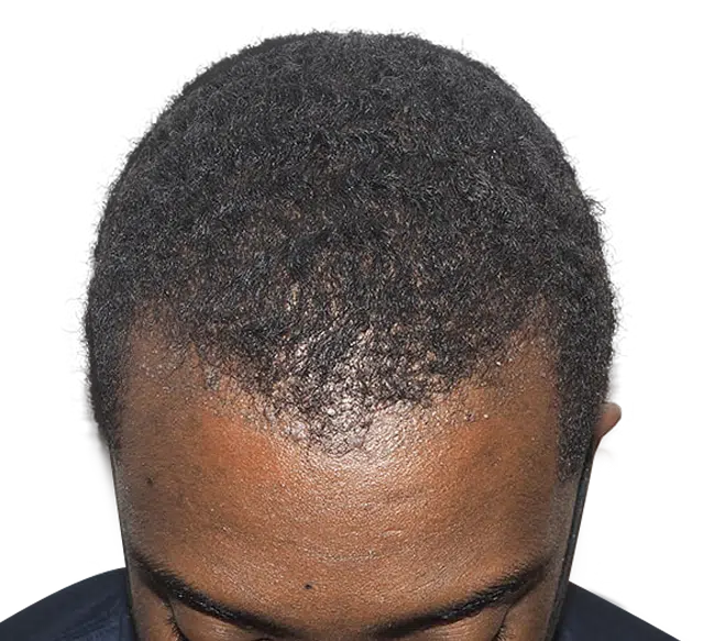 Hair Transplants for Curly Hair