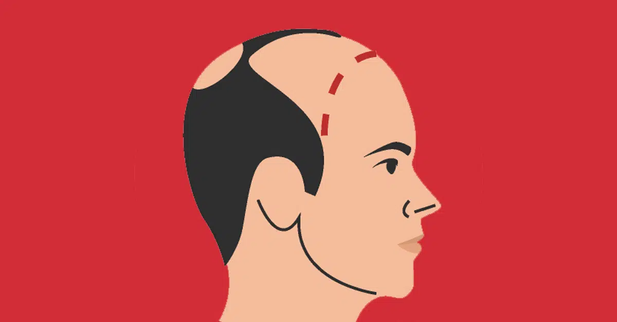 What is the best FUE method?