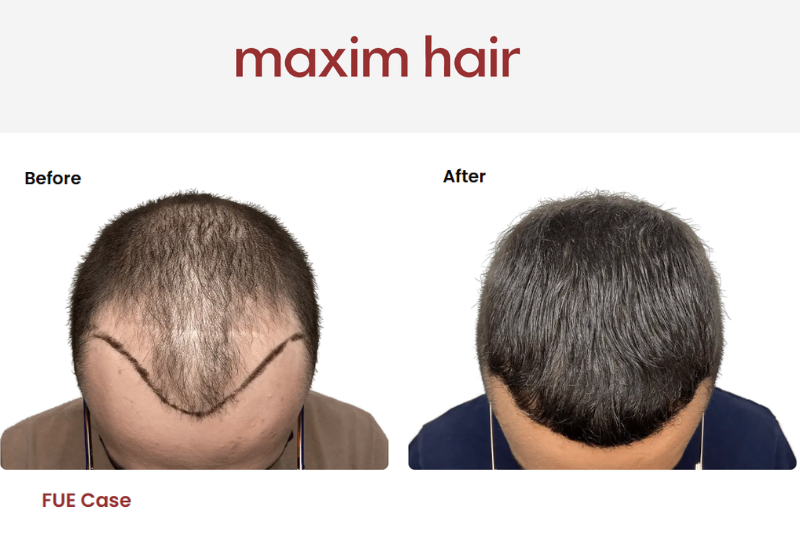 Before and after FUE transplant showing improvement in hair loss in 20s male pattern thinning