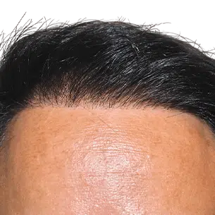 Before After 1