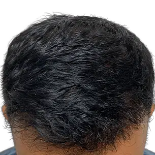 Before After 1